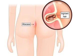 Laparoscopic Appendix Surgery Rajahmundry
