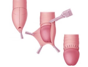 Laser Piles Surgery Rajahmundry