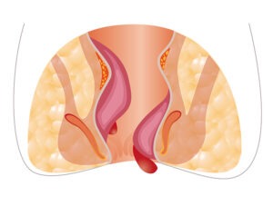 Best Fissure Treatment in Rajahmundry