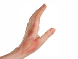 Cyst Removal Surgery Rajahmundry