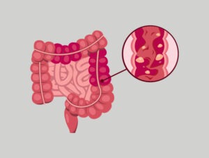 Hydrocele Treatment Rajahmundry
